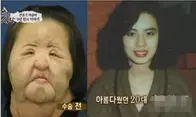 韩国“镜子公主”整容上瘾，自行注射大豆油，竟把脸整成电风扇